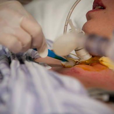 儿童最新款套管针免缝针,小儿套管针怎么扎视频